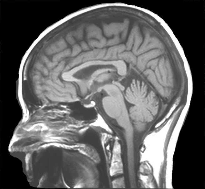 Sagittal View Of Brain Mri 5721